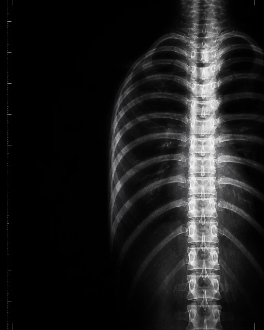 Radiographic study of a thoracic spine and ribcage, bone-white on near-black, with calibration marks along the margins.